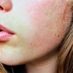 Quel soin pour les pores dilates : resserrer sa peau
