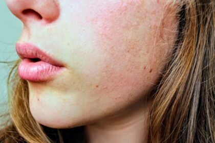 Quel soin pour les pores dilates : resserrer sa peau