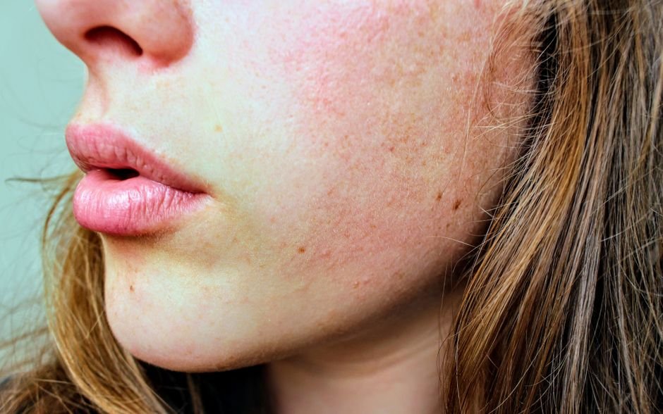 Quel soin pour les pores dilates : resserrer sa peau
